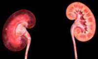 کلیه‌های آلوده هم قابل پیوند هستند
